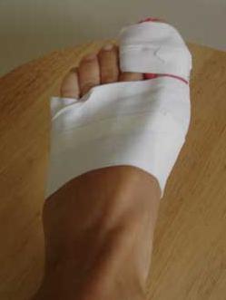 발가락의 골절 : 증상 및 치료